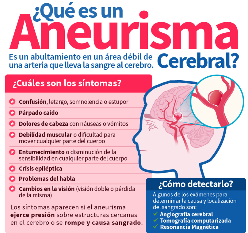 Hospital General de Culiacán innova en aneurisma cerebral ...